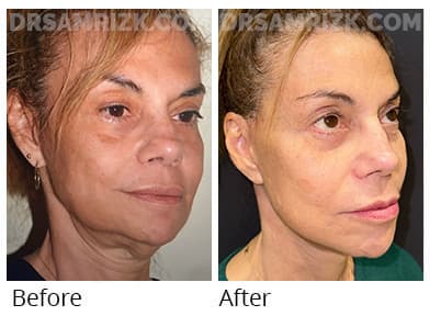 55 yo female shown 3 months post deep plane facelift / deep necklift to define jawline . Incisions look great and will continue to heal for up to a year .