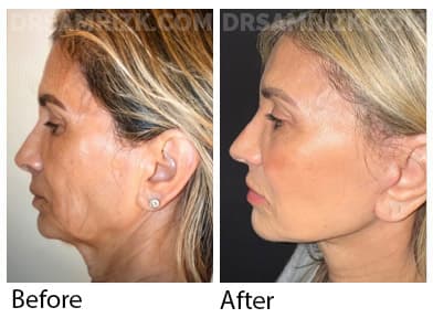 66 yo patient looking amazing one year after deep plane facelift / deep necklift / platysmaplasty / temporal browlift and fat transfer to cheek area / lower eyelids . Patient has great jawline and youthful cheeks looks 20 years younger