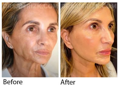 66 yo patient looking amazing one year after deep plane facelift / deep necklift / platysmaplasty / temporal browlift and fat transfer to cheek area / lower eyelids . Patient has great jawline and youthful cheeks looks 20 years younger