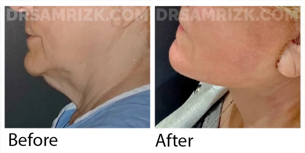 1 week post deep plane facelift / deep necklift