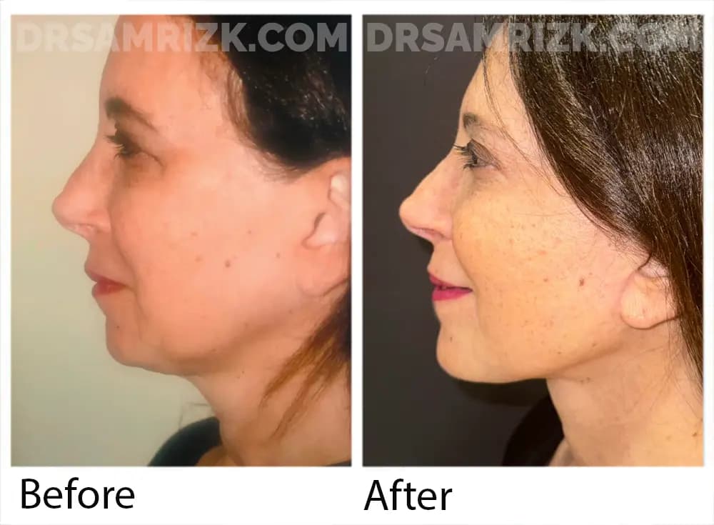 Patient is a New York plastic surgeon who underwent deep plane facelift / deep necklift / temporal browlift / upper blepharoplasty shown 1 year post