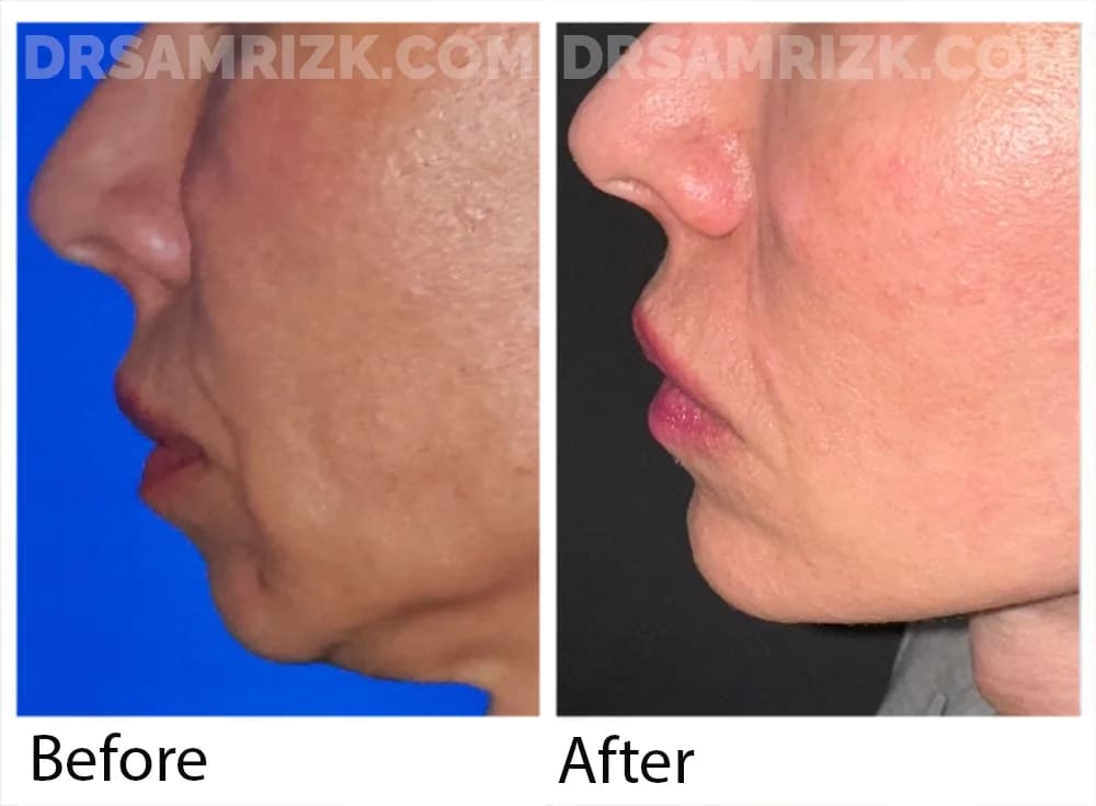 48 yo patient 1 year post deep plane facelift /necklift & chin implant