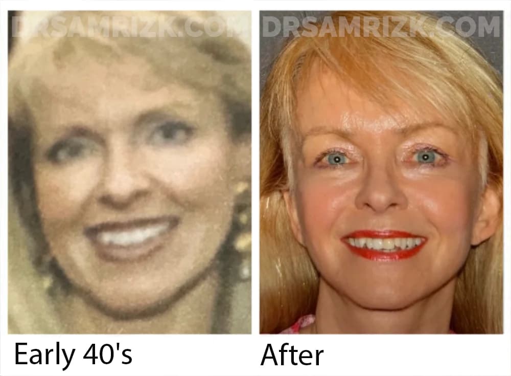 65 yo patient shown 9 months post deep plane facelift / necklift / temporal browlift / blepharoplasty with CANTHOPEXY / fat transfer cheeks and laser . Patient had brought her younger picture in early 40’s and post surgery she looks similar