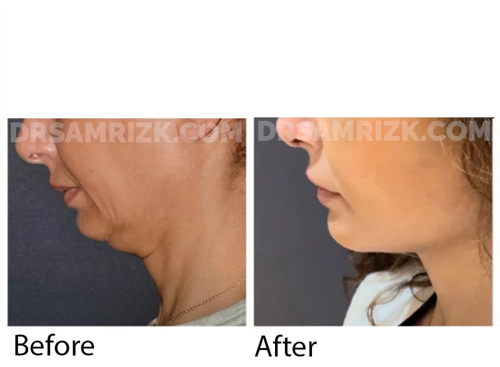 Patient is a New York plastic surgeon who underwent deep plane facelift / deep necklift / temporal browlift / upper blepharoplasty shown 1 year post
