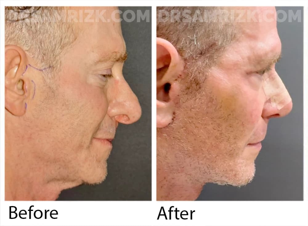 Patient is from Los Angeles and traveled to New York to undergo deep plane facelift / necklift / otoplasty & rhinoplasty and is shown 12 days post
