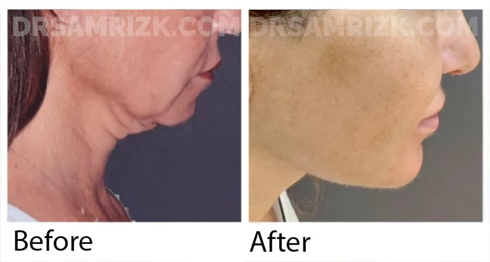 52 yo patient shown only 10 days post rapid recovery deep plane facelift / deep necklift / chin implant / lip lift / blepharoplasty & temporal browlift . Note how defined the jawline looks . Upper face hidden for patient privacy . This is still very early in healing period
