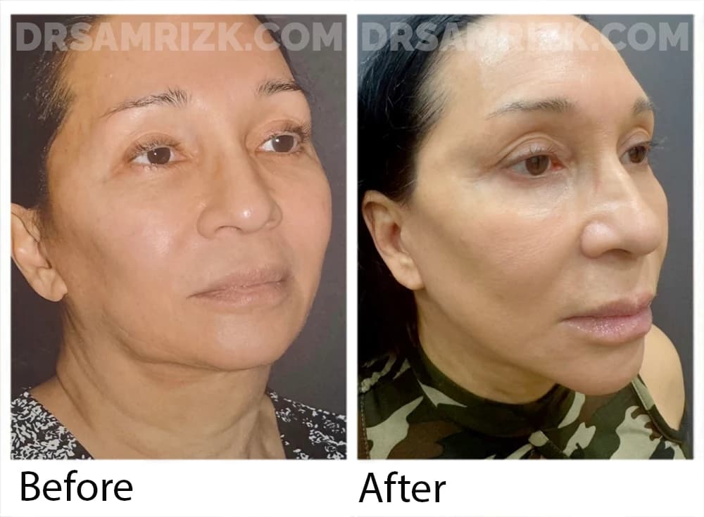 Patient is. 72 year old anesthesiologist shown 6 months post revision deep plane facelift / necklift and buccal fat reduction . Note jawline definition . Revision facelifts accounts for 50 % of Dr Rizk’s facelift surgery . We are honored many doctors trust us with their faces