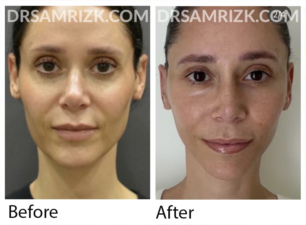 This 41 yo patient shown 2 weeks post deep plane facelift / Necklift 1