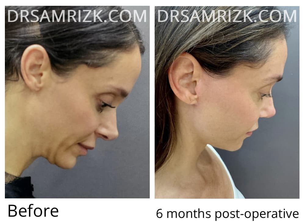 This 41 yo patient shown 2 weeks post deep plane facelift / Necklift 3