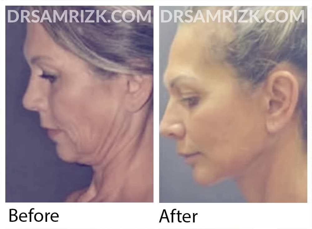 55 yo patient show 1 year post deep plane facelift / necklift performed live at Baker Gordon Symposium. Dr Rizk performed his novel rapid recovery deep plane facelift in front of thousands of plastic surgeons to teach most advanced techniques. 2