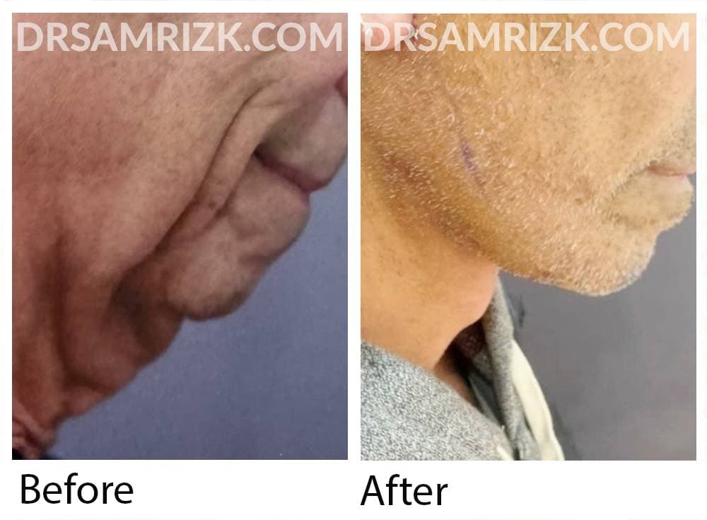 69 yo male patient shown only 3 days post rapid recovery deep plane facelift / necklift with tissue sealant and avoiding drains