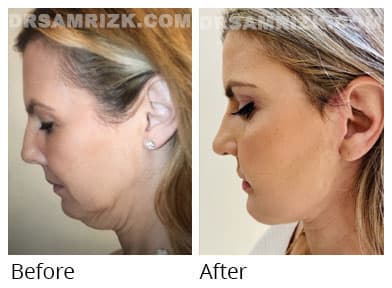 Female face, before and after Facelift treatment, side view, patient 50