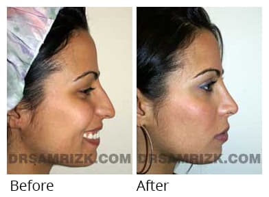 26 year old female with a long nose and drooping tip shown preoperative and 6 months after surgery. Patient sent her own picture 2 years after the surgery as a followup.
