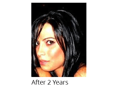 Female face, 2 years after Rhinoplasty treatment, oblique view, patient 1
