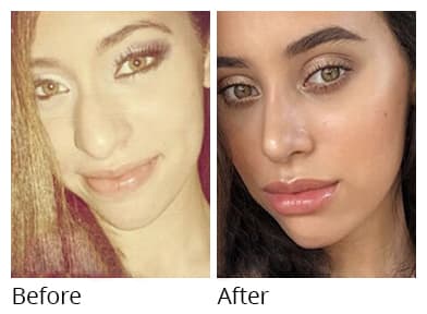 Female face, before and after Rhinoplasty treatment, front view, patient 3