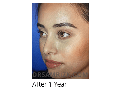 Female face, 1 year after Rhinoplasty treatment, oblique view, patient 3