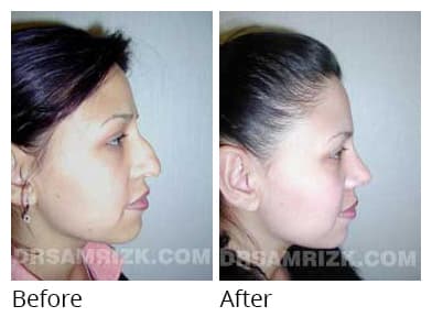32 year old female requests rhinoplasty because she was unhappy with tip and dorsal before her wedding. Postoperative pictures are shown 6 months after surgery.