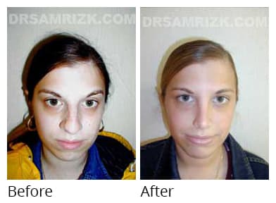 Female face, before and after Rhinoplasty treatment, front view, patient 16