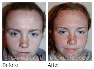 Female face, before and after Rhinoplasty treatment, front view, patient 32