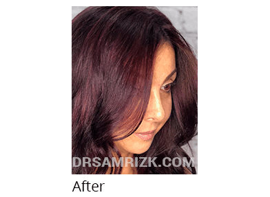 Female face, after Rhinoplasty treatment, side view, patient 39