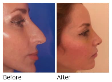 Female face, before and after Rhinoplasty treatment, side view, patient 51
