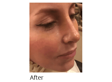 Female face, after Rhinoplasty treatment, oblique view, patient 51