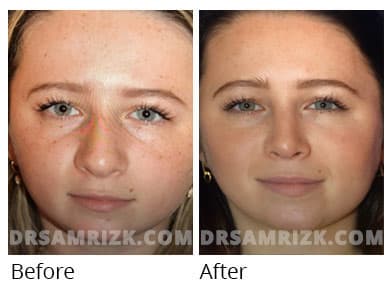 Female face, before and after Rhinoplasty treatment, front view, patient 55