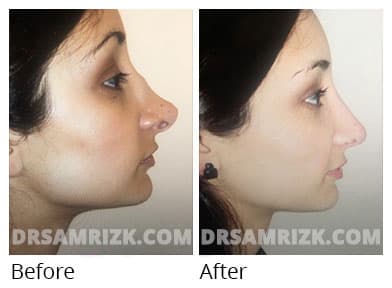 25yo patient underwent revision rhinoplasty with ear & banked rib shown 1 year post to correct saddle nose , open roof deformity , pinched tip , upturned nose and hanging columella.