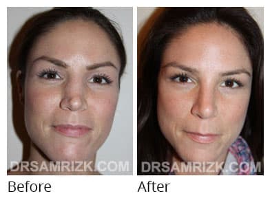 Female face, before and after Rhinoplasty treatment, front view, patient 66
