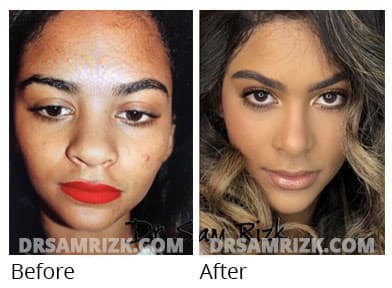 Female face, before and after Rhinoplasty treatment, front view, patient 70