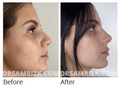 Patient shown 1 year after subtle but impactful rhinoplasty – she sent her own pictures post at 1 year . Bump was subtly removed and tip refined . Subtle rhinoplasties can have dramatic impacts.