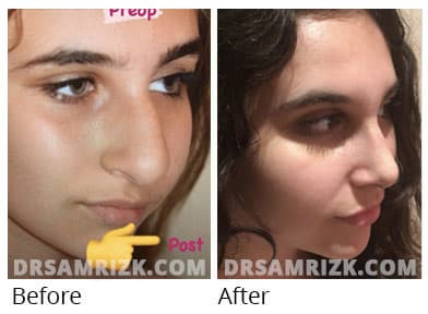 Female face, before and after Rhinoplasty treatment, side view, patient 71