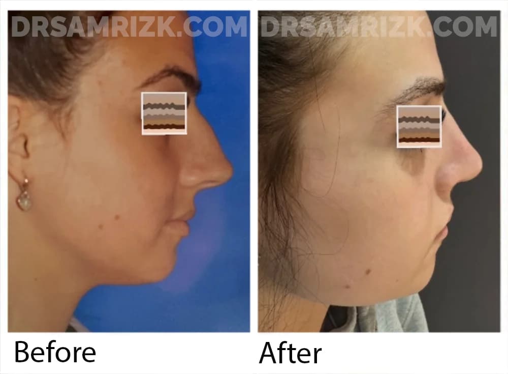 1 year post teenager rhinopasty