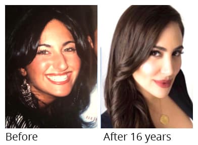 Female face, before and 16 years after Rhinoplasty treatment, oblique view, patient 9