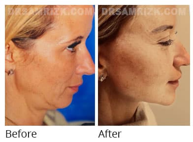45 yo patient shown 3 years after deep plane facelift /deep neck lift.