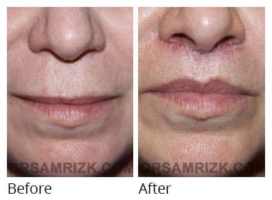 Woman's face, before and after Lip Lift treatment, front view, patient 1