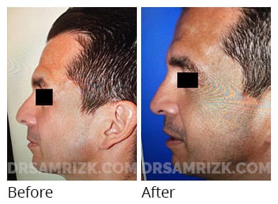 Woman's face, before and after Revision Rhinoplasty treatment, l-side view