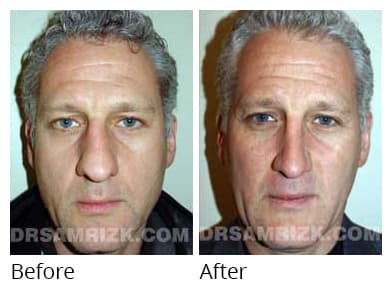 Male face, before and after Rhinoplasty treatment, front view, patient 4