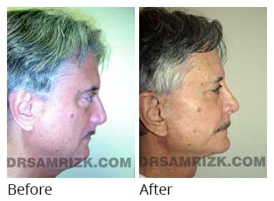 Male face, before and after Rhinoplasty treatment, side view, patient 7