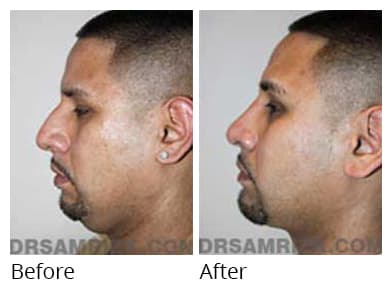 Male face, before and after Rhinoplasty treatment, side view, patient 14