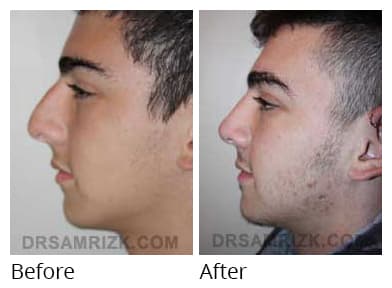 Male face, before and after Rhinoplasty treatment, side view, patient 26