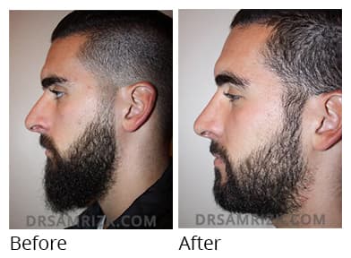 Male face, before and after Rhinoplasty treatment, side view, patient 27