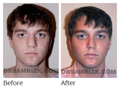 Male face, before and after Rhinoplasty treatment, front view, patient 33