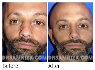 Woman's face, before and after Revision Rhinoplasty treatment, front view