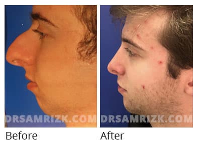 Woman's face, before and after Revision Rhinoplasty treatment, front view