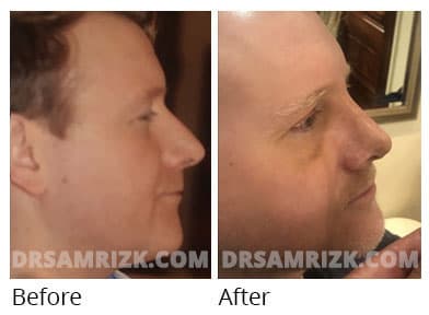 Woman's face, before and after Revision Rhinoplasty treatment, front view