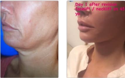 Woman's face, Before and After Rhinoplasty Treatment, front view, patient 1