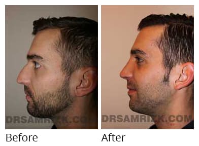 Male face, before and after Rhinoplasty treatment, l-side view (patient 1)