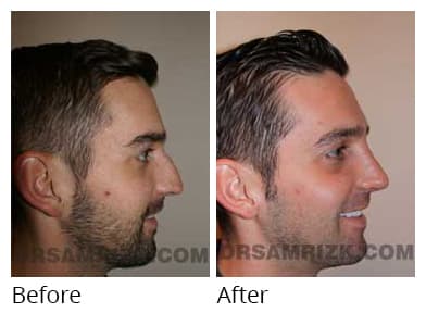 Male face, before and after Rhinoplasty treatment, r-side view (patient 1)