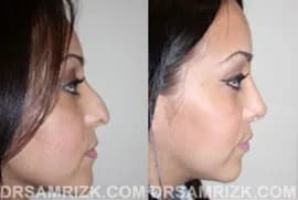 25 yo female wishes to improve drooping nasal tip, bump and bulbous nasal tip. Patient underwent open rhinoplasty with tip support with her own septum cartilage to achieve a better long term result of tip support. Tip was also refined with cartilage reduction and suture techniques, and bump was removed naturally. Patient is shown 1 year after nose surgery.